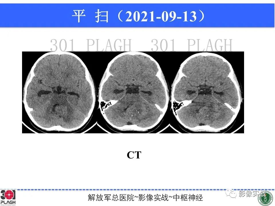 影像PPT - 【病例】幕下室管膜瘤1例MR影像诊断思路-17