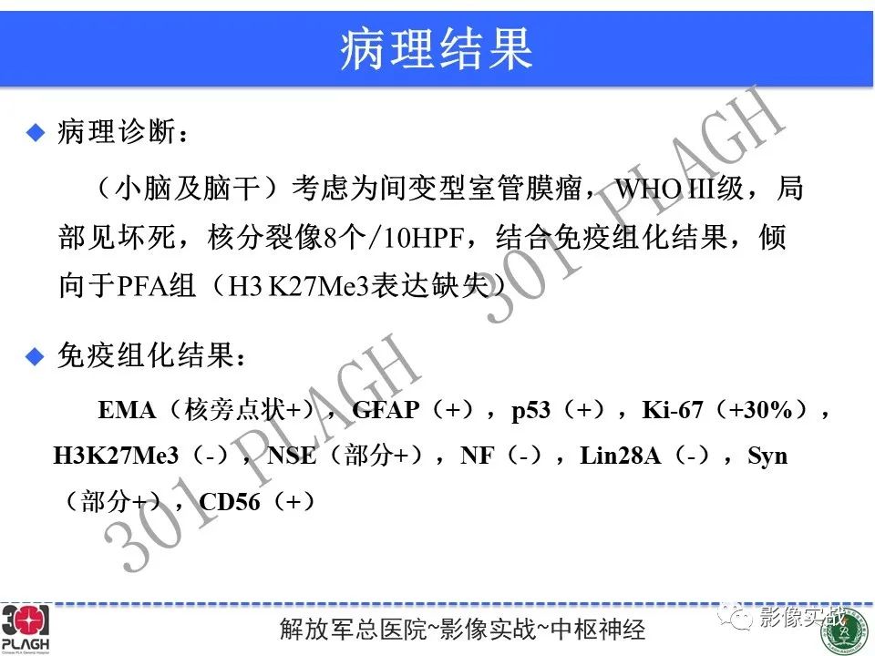 影像PPT - 【病例】幕下室管膜瘤1例MR影像诊断思路-26