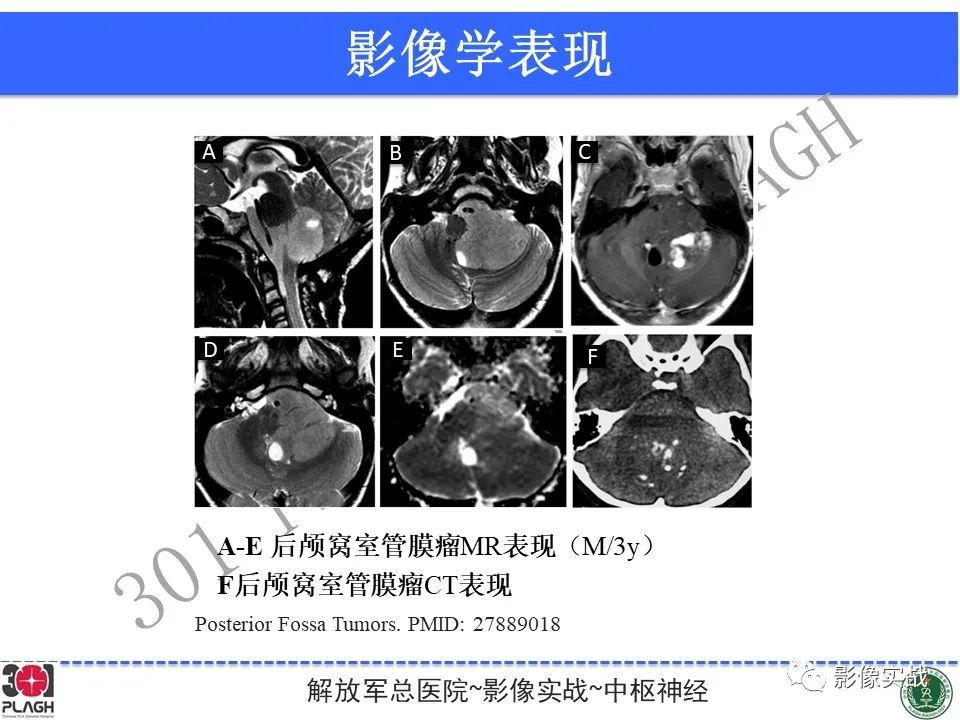 影像PPT - 【病例】幕下室管膜瘤1例MR影像诊断思路-31