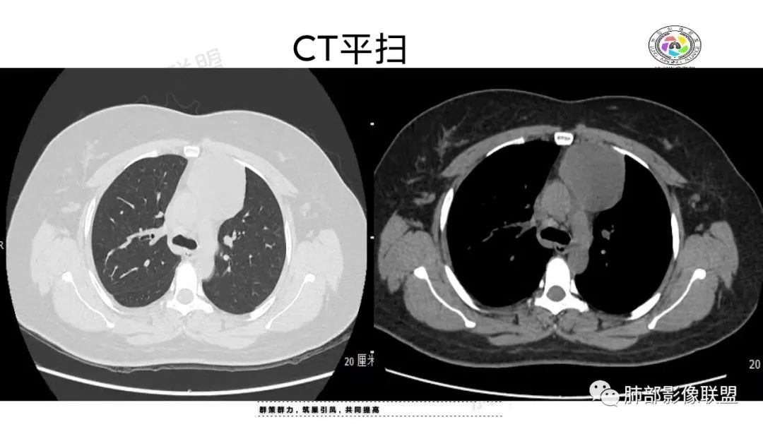 影像PPT - 【病例】前纵隔囊性病变—成熟性畸胎瘤1例CT影像-5