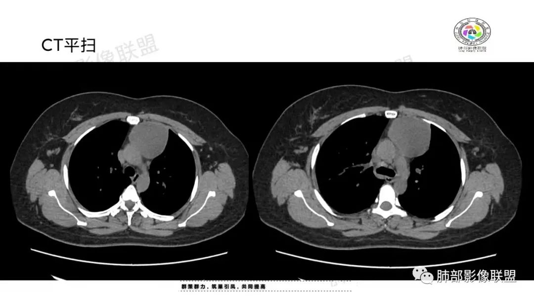 影像PPT - 【病例】前纵隔囊性病变—成熟性畸胎瘤1例CT影像-6