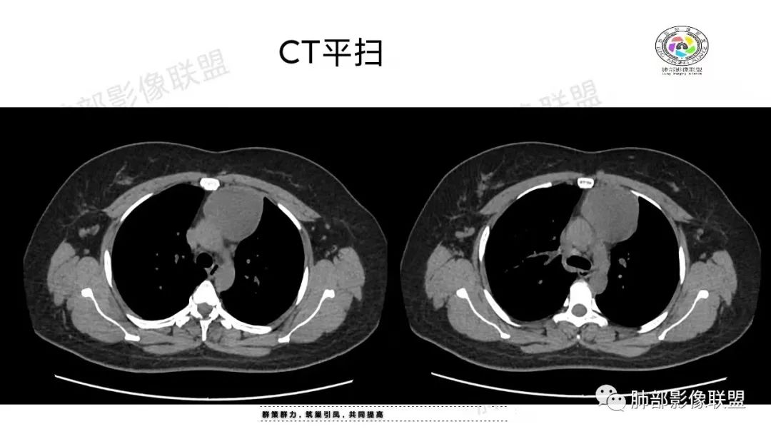 影像PPT - 【病例】前纵隔囊性病变—成熟性畸胎瘤1例CT影像-7