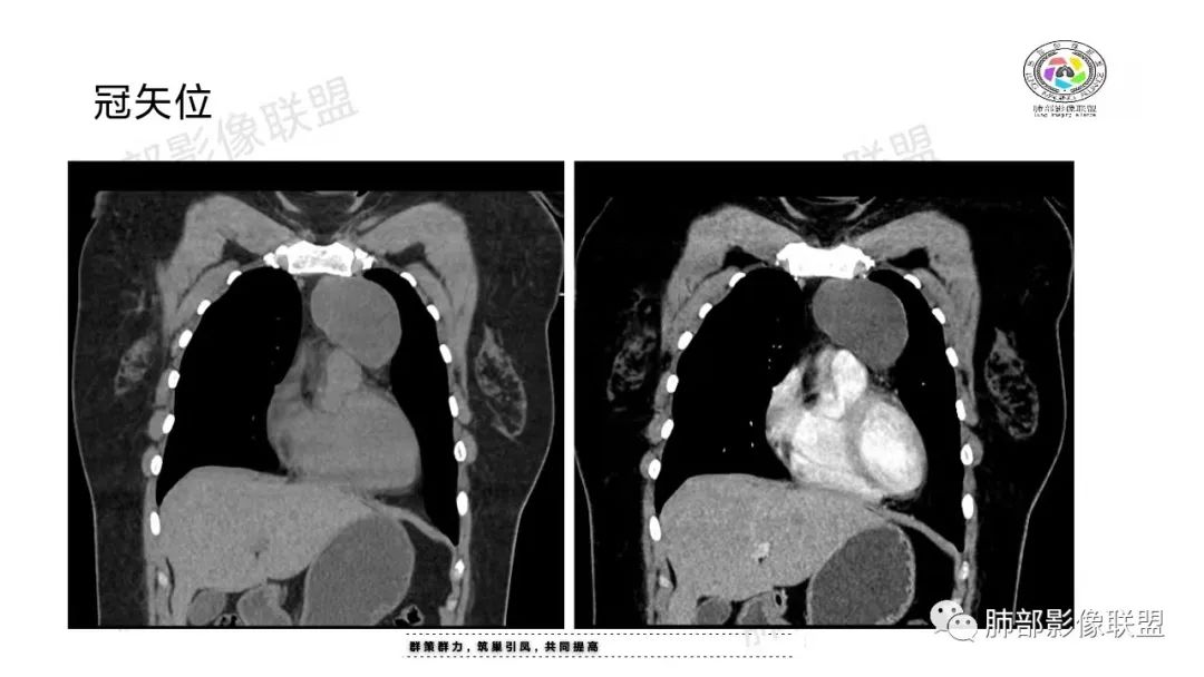 影像PPT - 【病例】前纵隔囊性病变—成熟性畸胎瘤1例CT影像-11