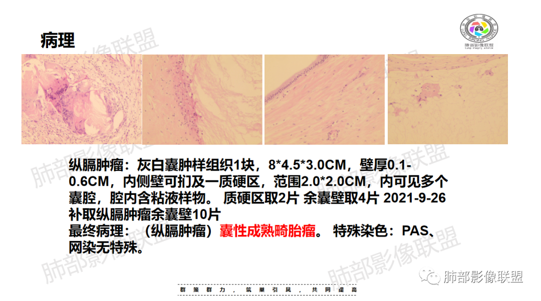 影像PPT - 【病例】前纵隔囊性病变—成熟性畸胎瘤1例CT影像-17