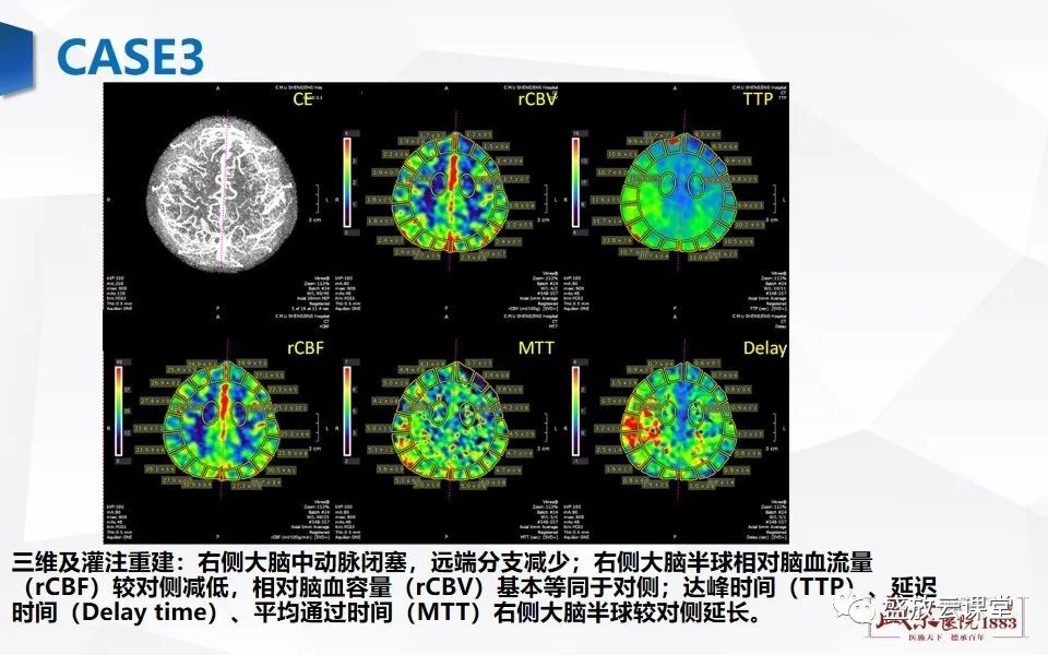 影像PPT - 【PPT】脑CT灌注成像中各测量值的意义-14