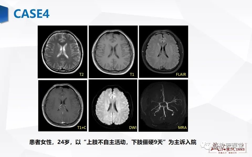 影像PPT - 【PPT】脑CT灌注成像中各测量值的意义-15