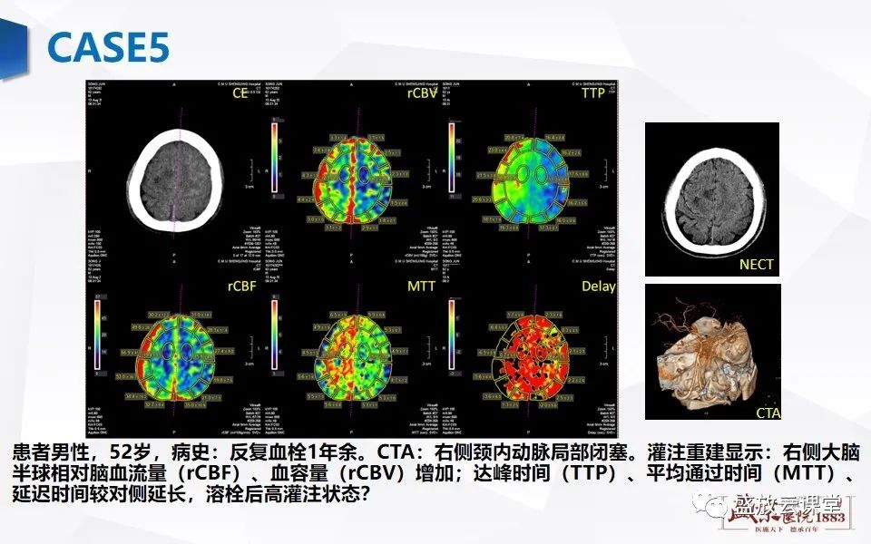 影像PPT - 【PPT】脑CT灌注成像中各测量值的意义-17