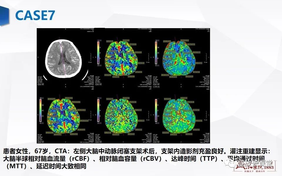 影像PPT - 【PPT】脑CT灌注成像中各测量值的意义-19