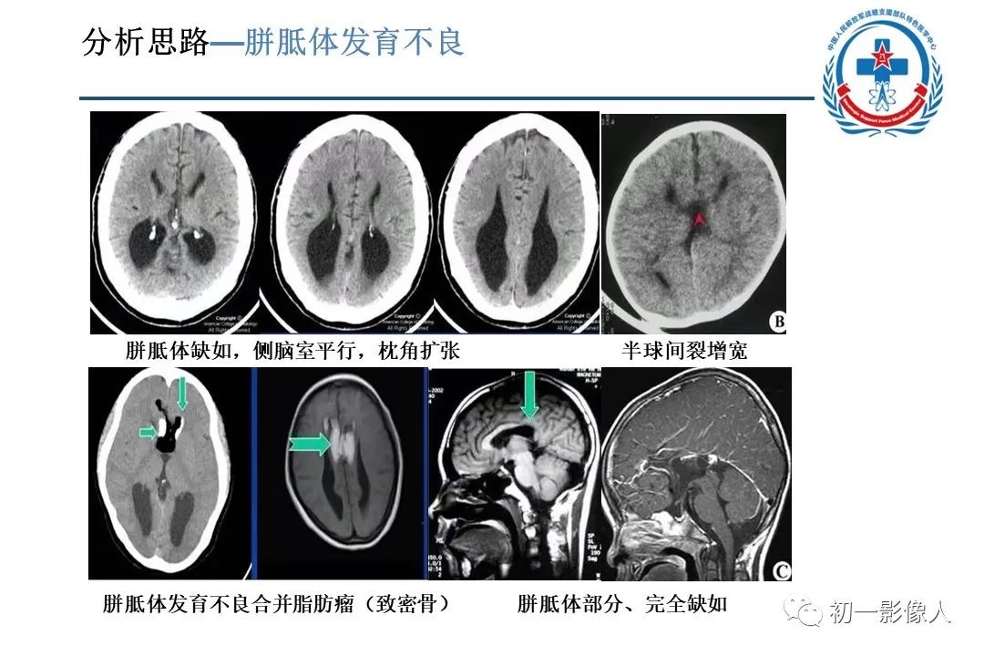 影像PPT - 【PPT】原发性胼胝体变性MBD-9