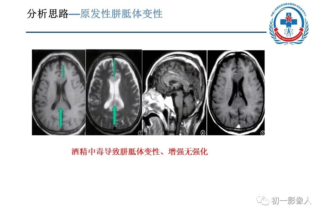影像PPT - 【PPT】原发性胼胝体变性MBD-12