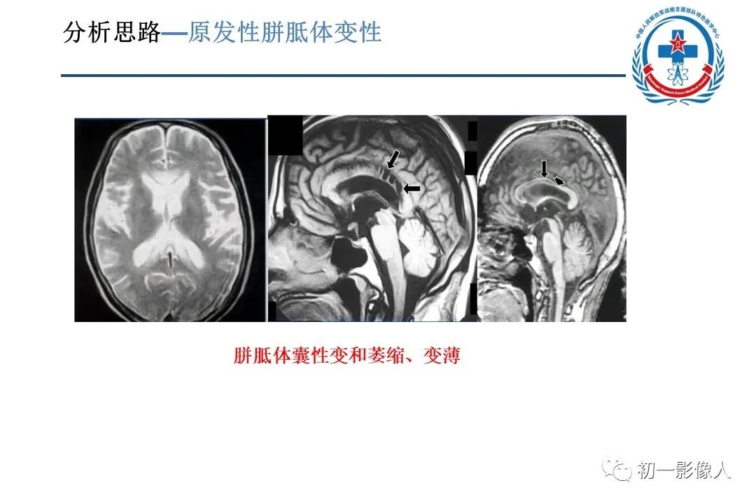影像PPT - 【PPT】原发性胼胝体变性MBD-13