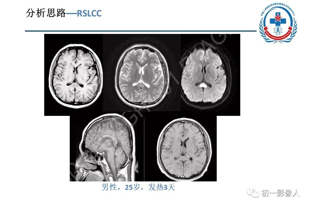 影像PPT - 【PPT】原发性胼胝体变性MBD-15