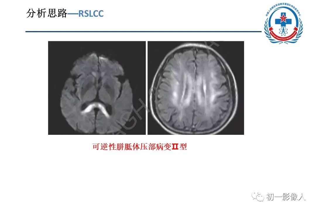 影像PPT - 【PPT】原发性胼胝体变性MBD-16