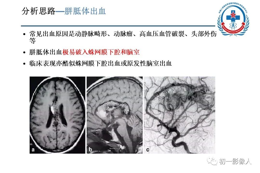影像PPT - 【PPT】原发性胼胝体变性MBD-17