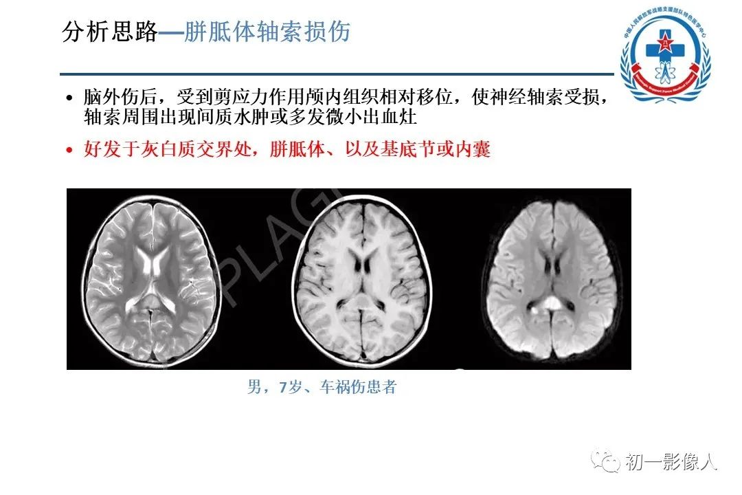 影像PPT - 【PPT】原发性胼胝体变性MBD-18