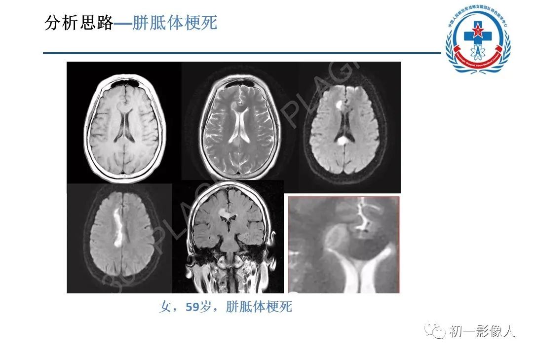 影像PPT - 【PPT】原发性胼胝体变性MBD-20