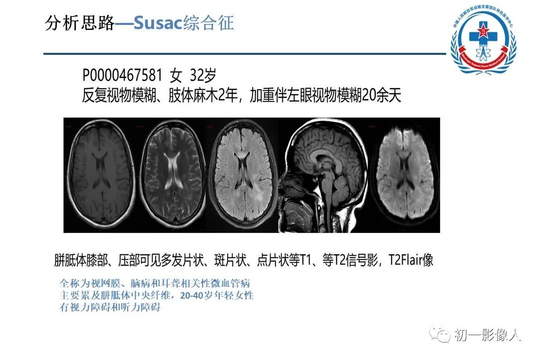 影像PPT - 【PPT】原发性胼胝体变性MBD-21