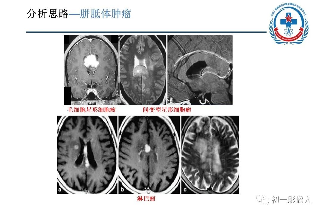 影像PPT - 【PPT】原发性胼胝体变性MBD-22