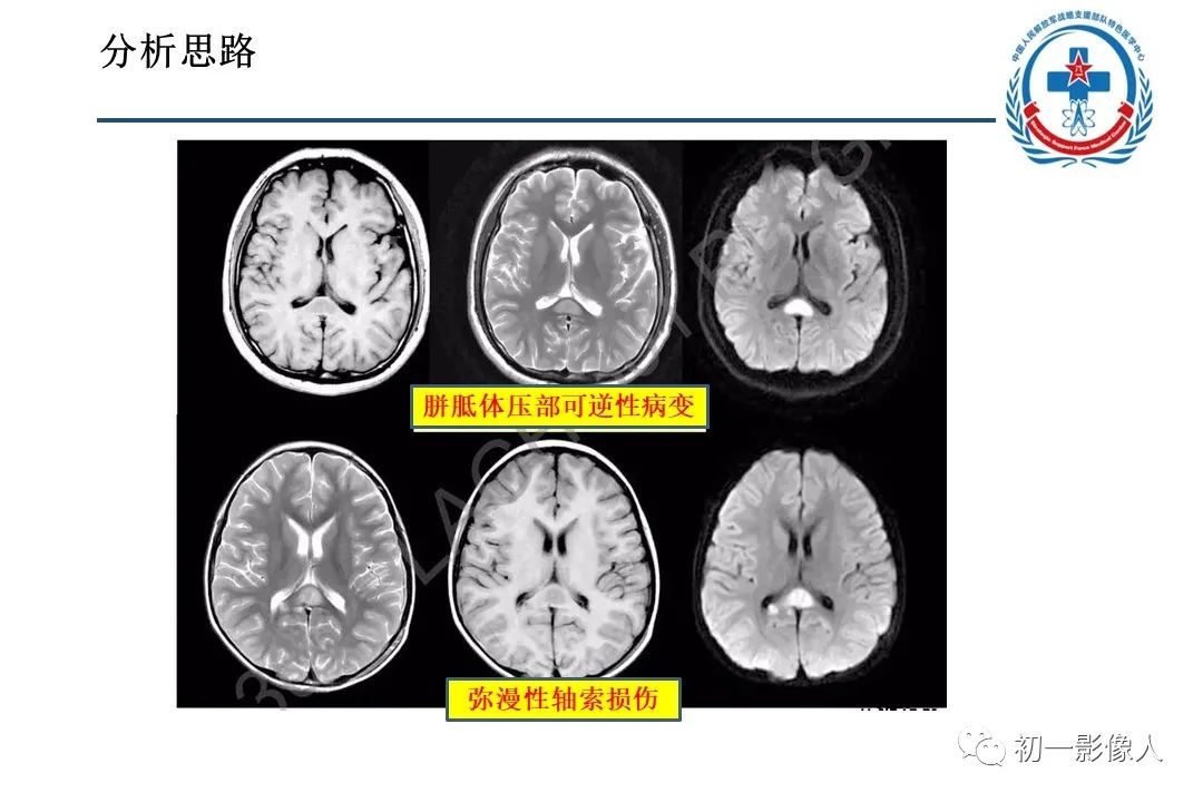 影像PPT - 【PPT】原发性胼胝体变性MBD-24