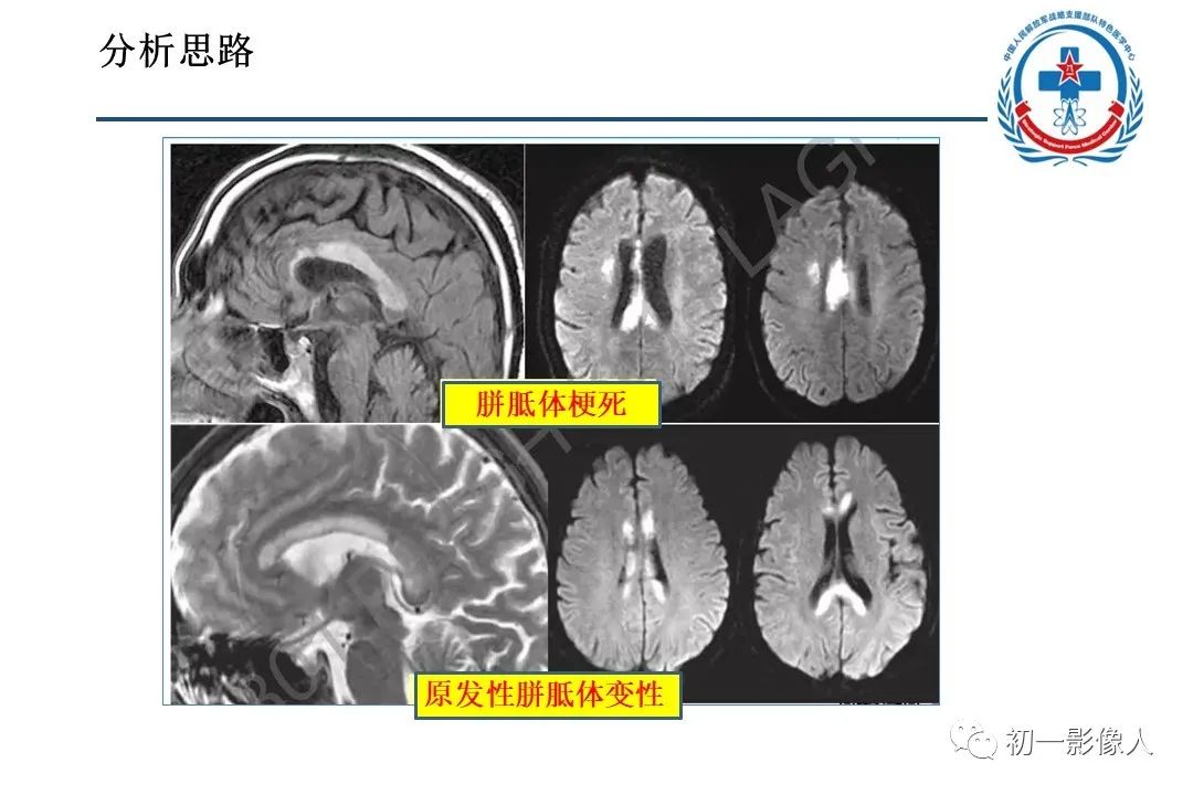 影像PPT - 【PPT】原发性胼胝体变性MBD-25