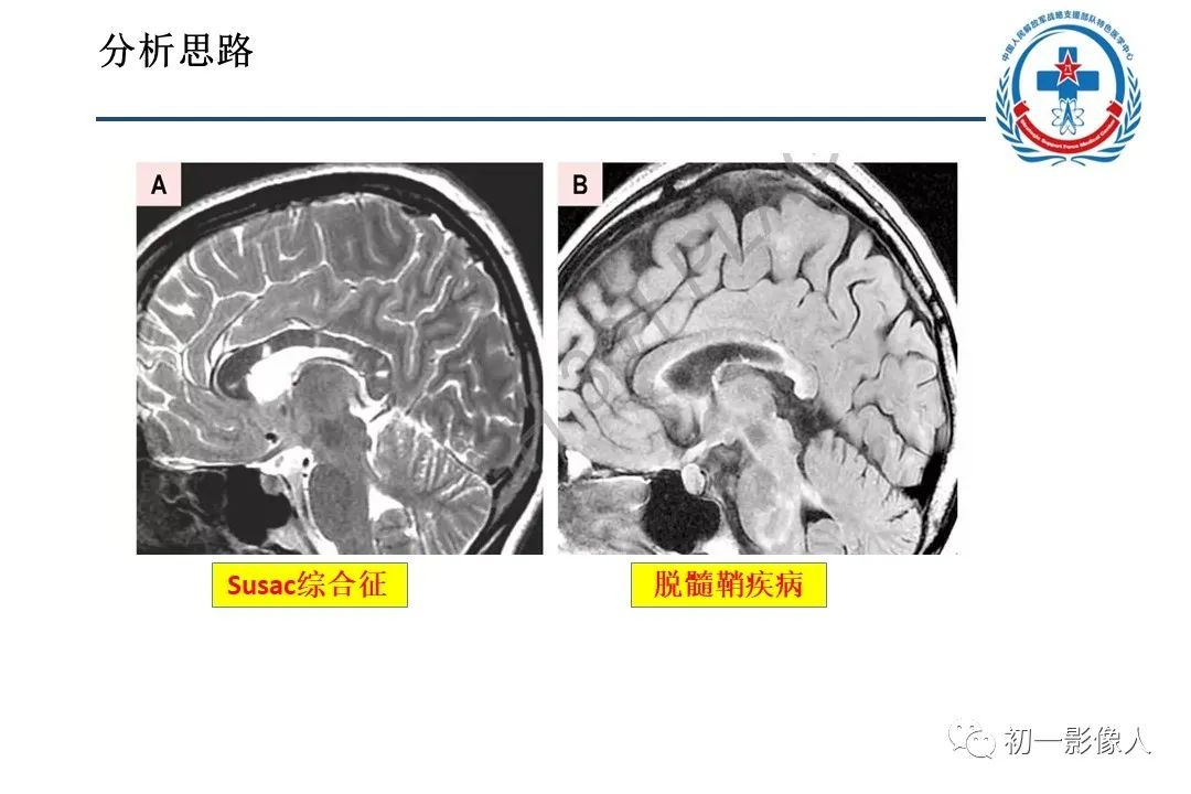 影像PPT - 【PPT】原发性胼胝体变性MBD-26