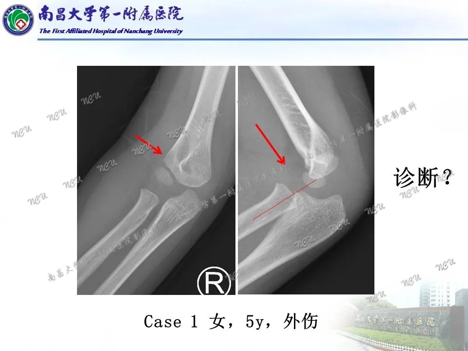 影像PPT - 【PPT】儿童肘关节骨折X线诊断-2