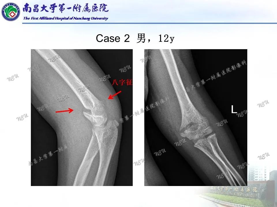 影像PPT - 【PPT】儿童肘关节骨折X线诊断-4