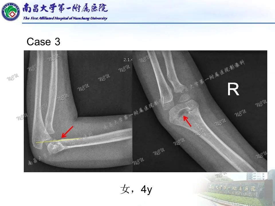 影像PPT - 【PPT】儿童肘关节骨折X线诊断-5