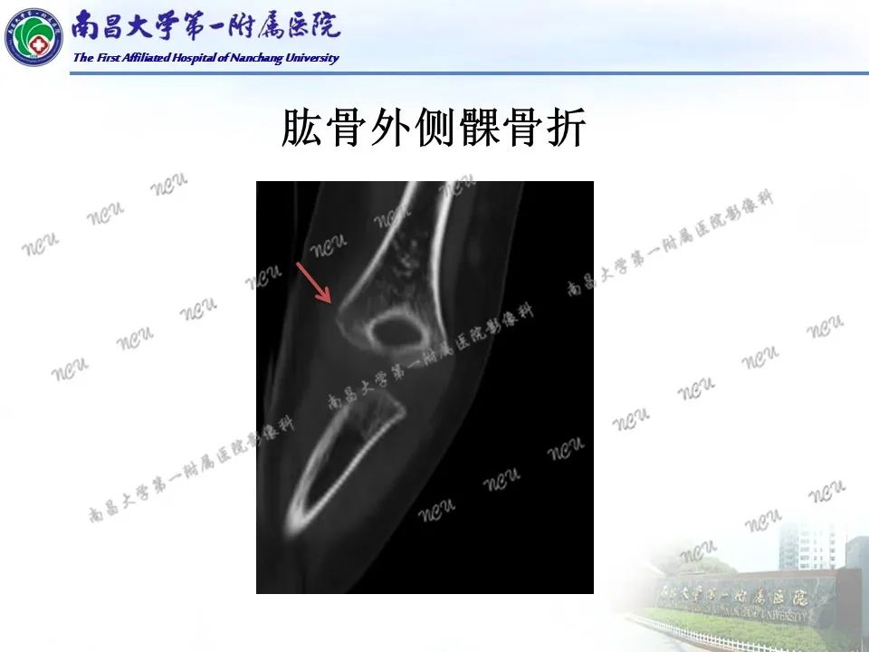影像PPT - 【PPT】儿童肘关节骨折X线诊断-3