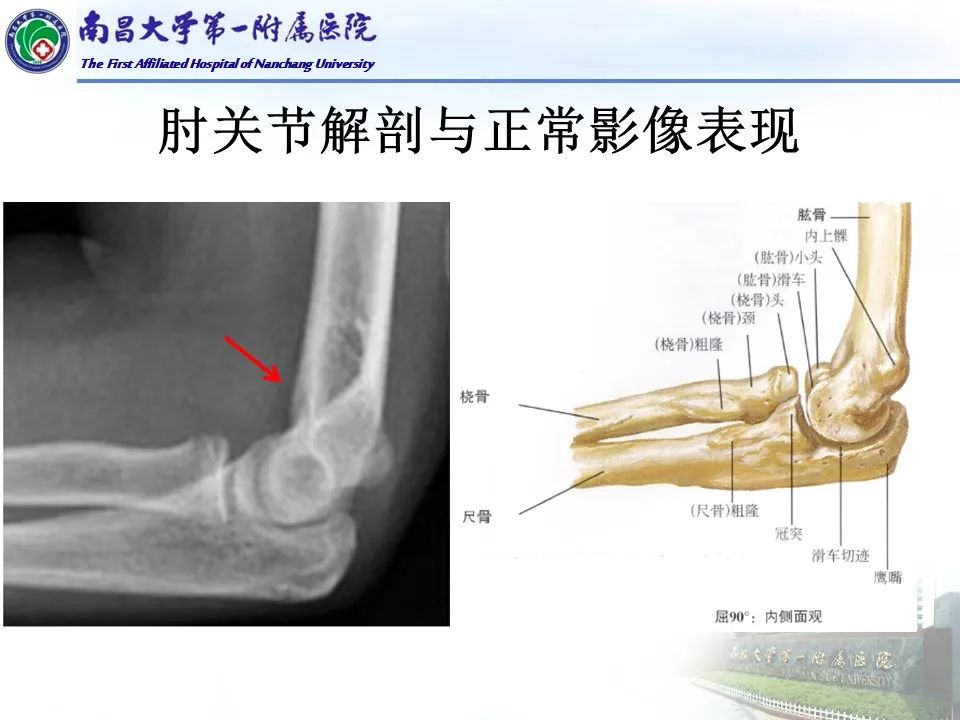 影像PPT - 【PPT】儿童肘关节骨折X线诊断-8