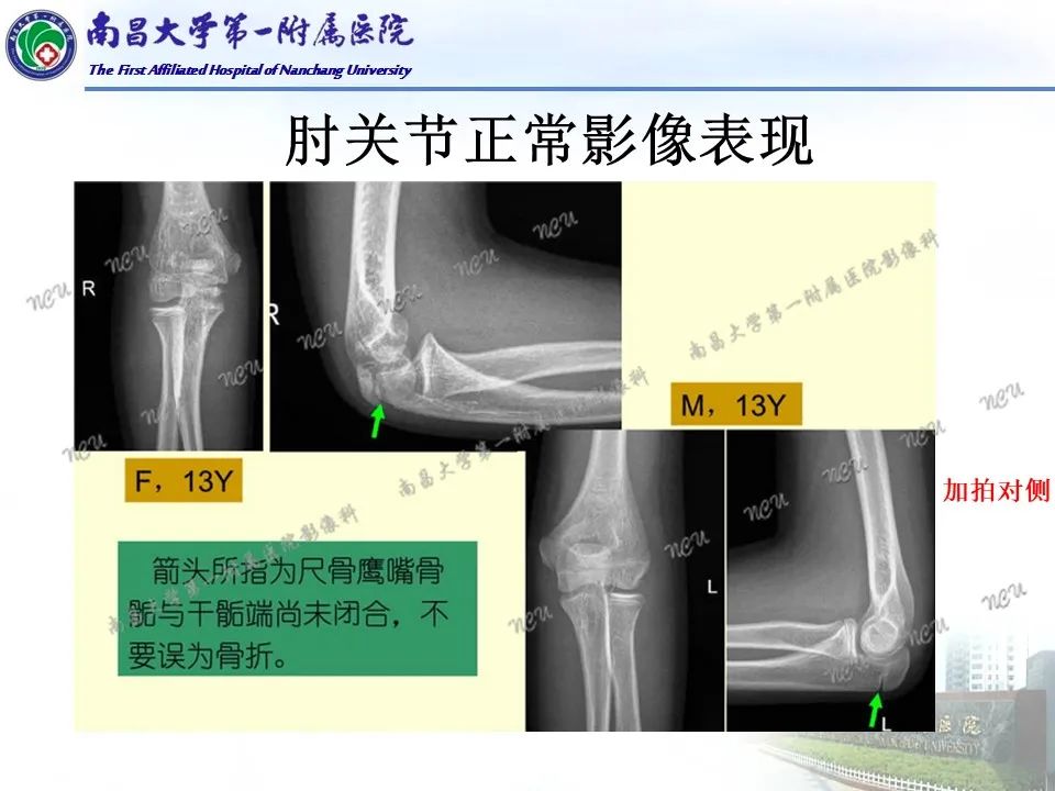 影像PPT - 【PPT】儿童肘关节骨折X线诊断-11