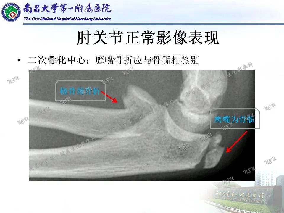 影像PPT - 【PPT】儿童肘关节骨折X线诊断-12