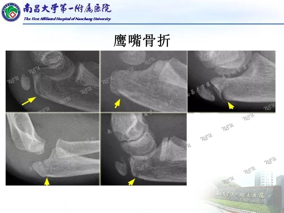 影像PPT - 【PPT】儿童肘关节骨折X线诊断-13