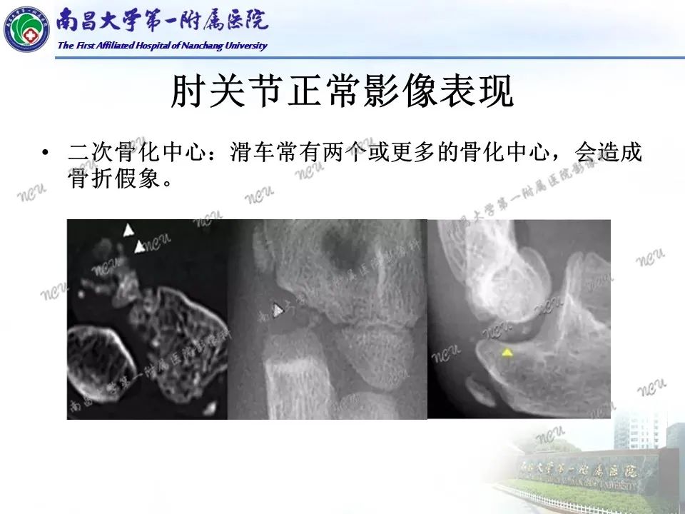 影像PPT - 【PPT】儿童肘关节骨折X线诊断-14