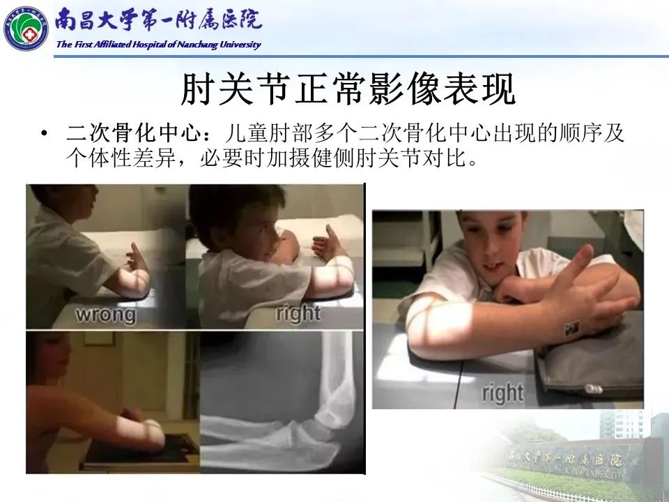 影像PPT - 【PPT】儿童肘关节骨折X线诊断-15
