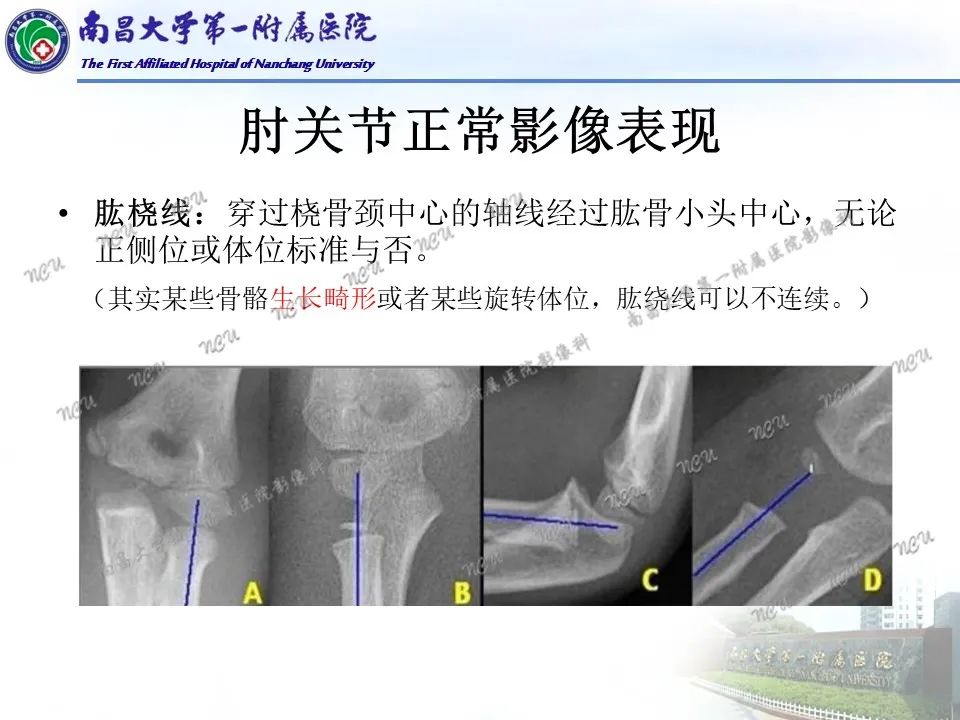 影像PPT - 【PPT】儿童肘关节骨折X线诊断-16