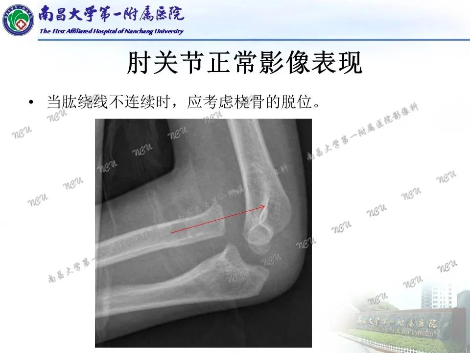 影像PPT - 【PPT】儿童肘关节骨折X线诊断-17