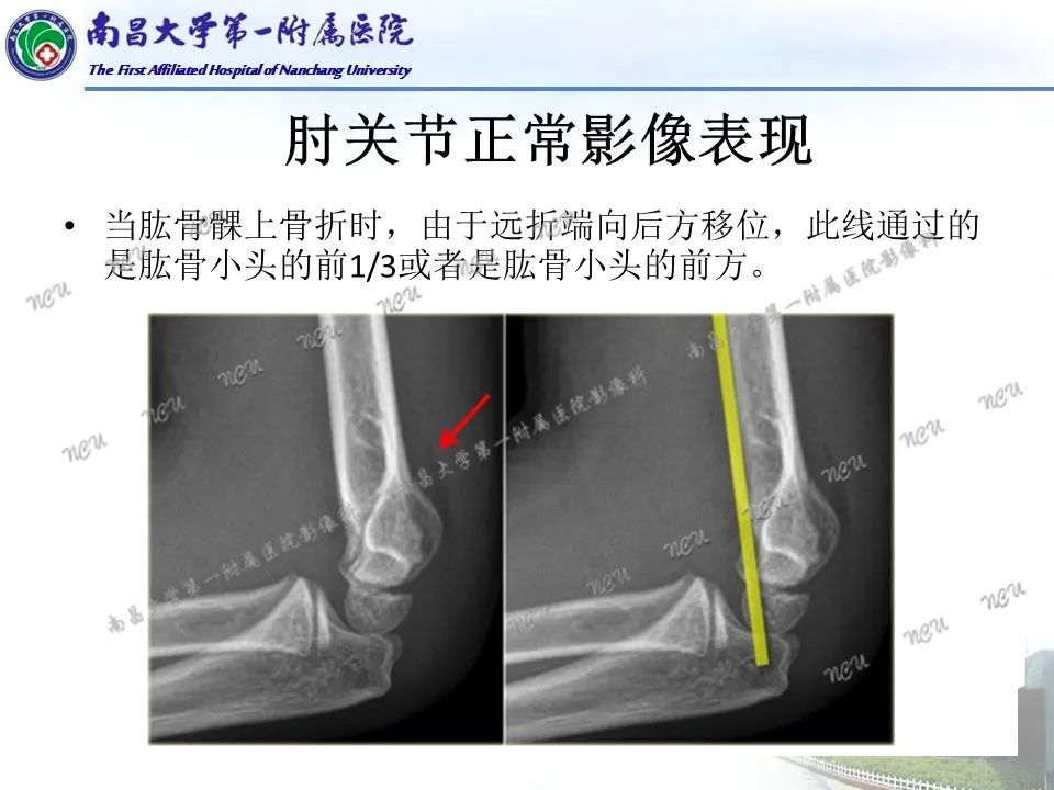 影像PPT - 【PPT】儿童肘关节骨折X线诊断-19