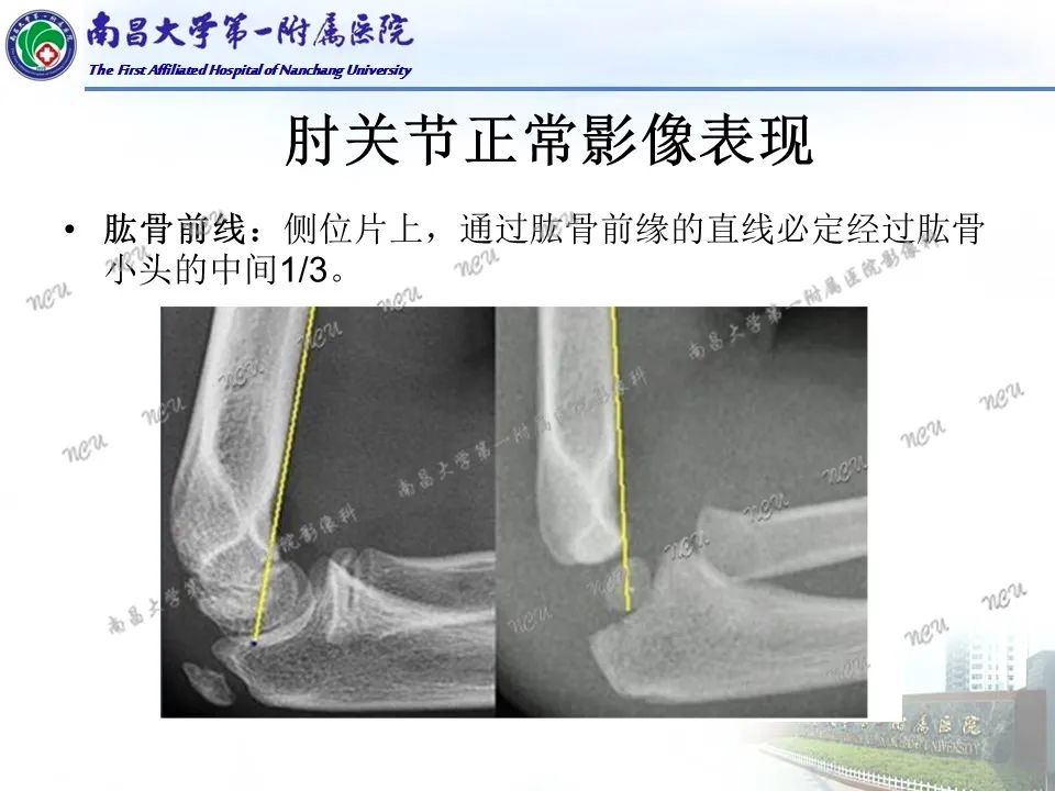 影像PPT - 【PPT】儿童肘关节骨折X线诊断-18
