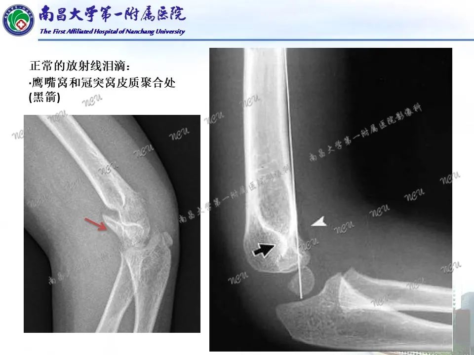 影像PPT - 【PPT】儿童肘关节骨折X线诊断-20