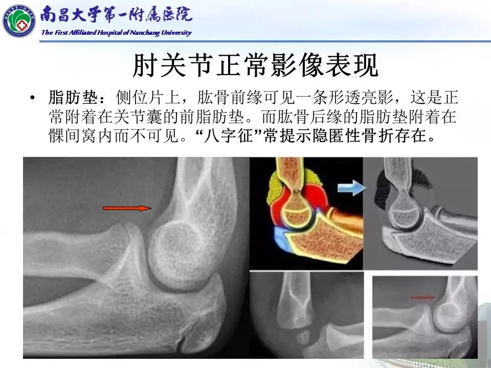 影像PPT - 【PPT】儿童肘关节骨折X线诊断-21