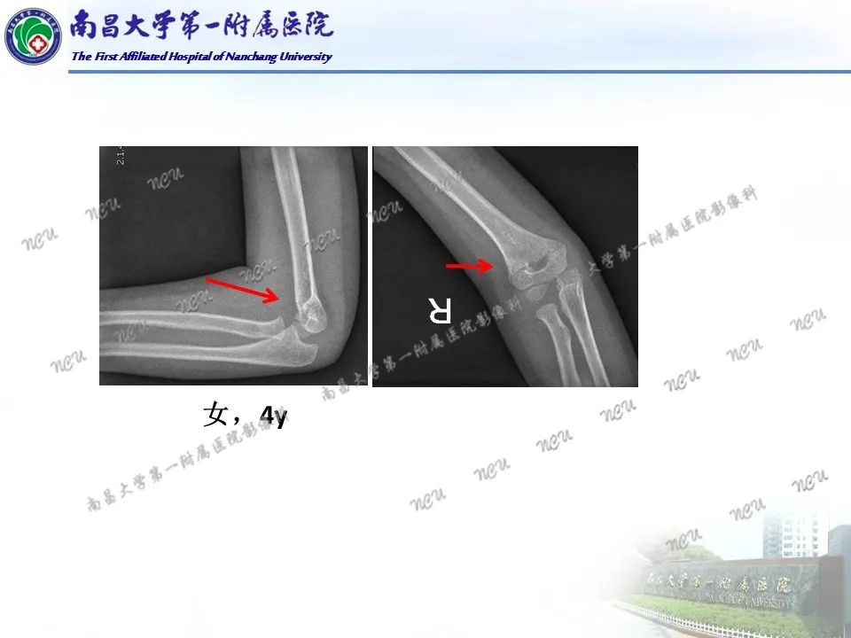 影像PPT - 【PPT】儿童肘关节骨折X线诊断-22