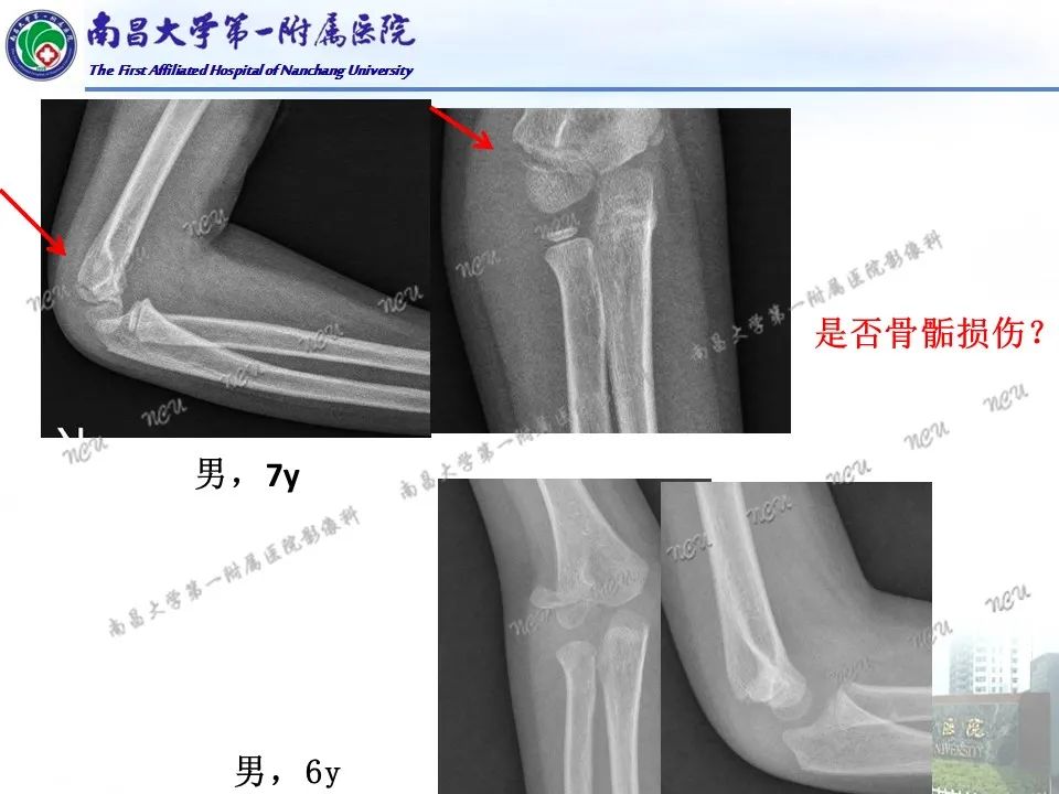 影像PPT - 【PPT】儿童肘关节骨折X线诊断-23
