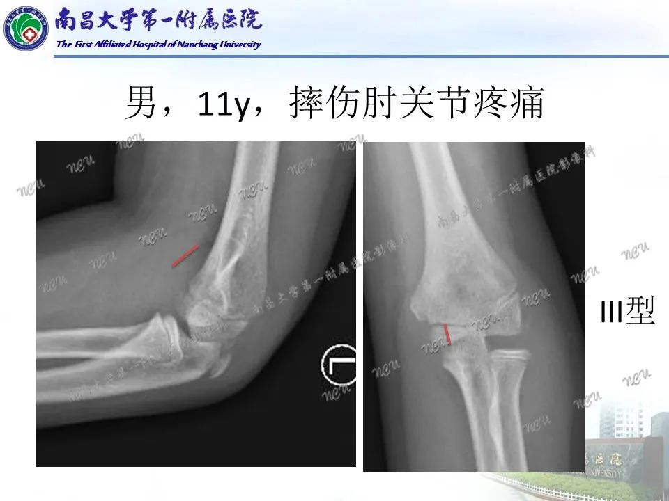 影像PPT - 【PPT】儿童肘关节骨折X线诊断-25