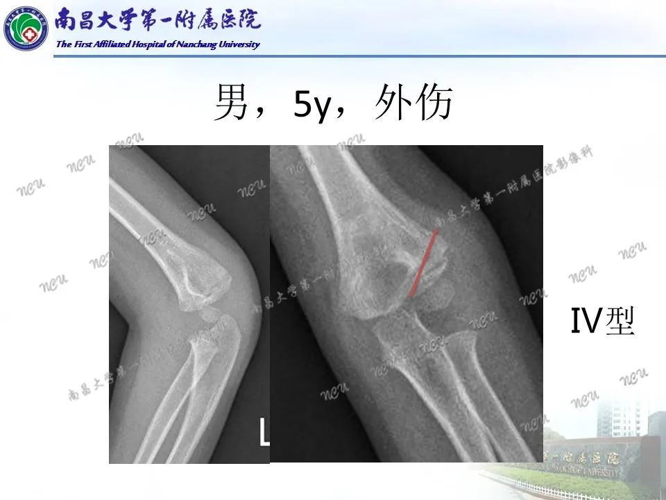 影像PPT - 【PPT】儿童肘关节骨折X线诊断-26