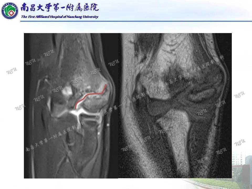 影像PPT - 【PPT】儿童肘关节骨折X线诊断-27