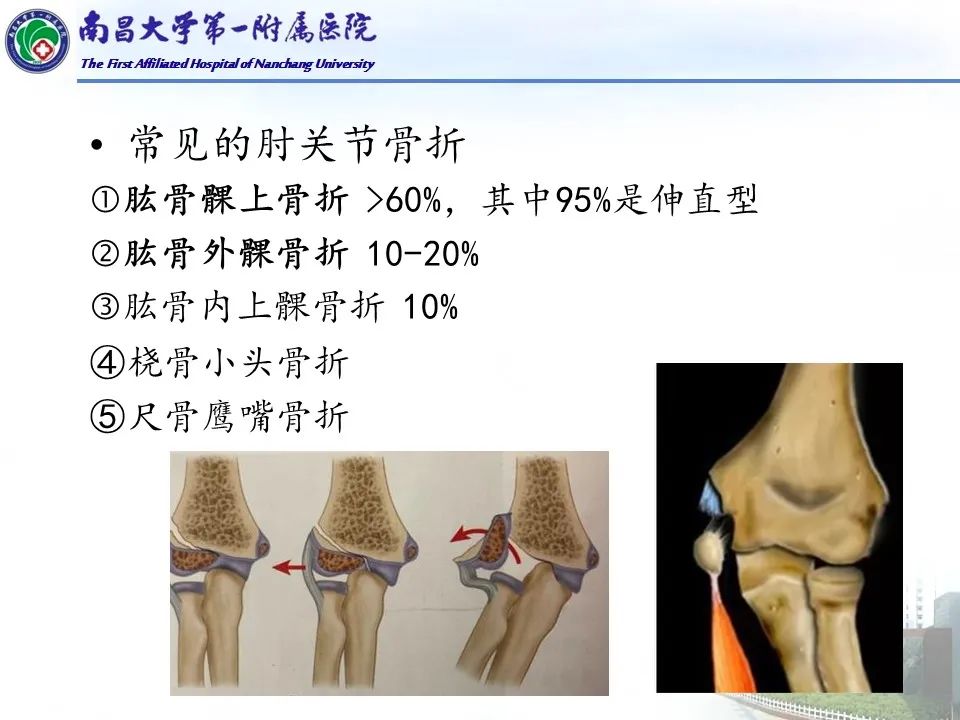 影像PPT - 【PPT】儿童肘关节骨折X线诊断-28