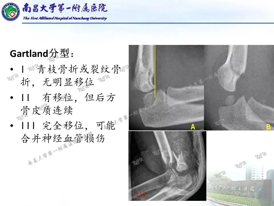 影像PPT - 【PPT】儿童肘关节骨折X线诊断-30