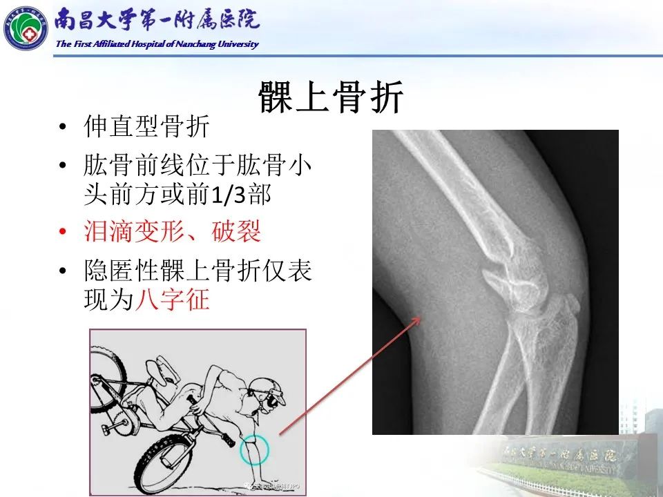 影像PPT - 【PPT】儿童肘关节骨折X线诊断-29