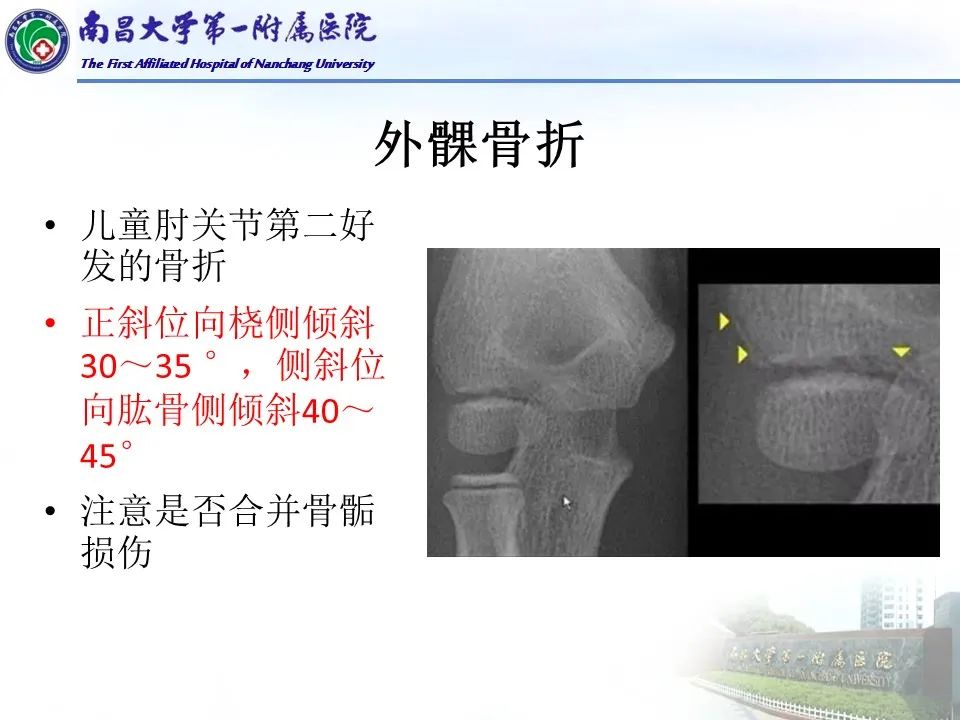 影像PPT - 【PPT】儿童肘关节骨折X线诊断-32
